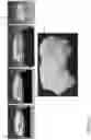 Fig. 02 - Method for generating a 3D physical model of a patient specific anatomic feature from 2D medical images