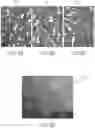 Fig. 11 - DEVICES AND METHODS FOR TREATING A FISTULA