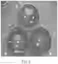 Fig. 12 - DEVICES AND METHODS FOR TREATING A FISTULA