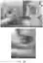 Fig. 16 - DEVICES AND METHODS FOR TREATING A FISTULA