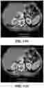 Fig. 59 - Systems, methods, and devices for medical image analysis, diagnosis, risk stratification, decision making and/or disease tracking