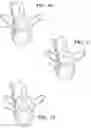 Fig. 08 - Surgical drilling system for determining bone breakthrough