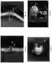 Fig. 43 - SYSTEMS, METHODS, AND DEVICES FOR MEDICAL IMAGE ANALYSIS, DIAGNOSIS, RISK STRATIFICATION, DECISION MAKING AND/OR DISEASE TRACKING