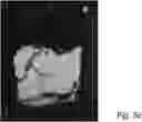 Fig. 08 - IMAGE REGISTRATION WITH APPLICATION IN TISSUE TREATMENT