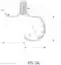 Fig. 14 - DEVICE, SYSTEM, AND METHOD FOR TRANSCATHETER TREATMENT OF VALVULAR REGURGITATION
