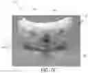 Fig. 17 - DEVICE, SYSTEM, AND METHOD FOR TRANSCATHETER TREATMENT OF VALVULAR REGURGITATION