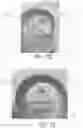 Fig. 18 - DEVICE, SYSTEM, AND METHOD FOR TRANSCATHETER TREATMENT OF VALVULAR REGURGITATION