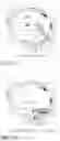 Fig. 28 - DEVICE, SYSTEM, AND METHOD FOR TRANSCATHETER TREATMENT OF VALVULAR REGURGITATION