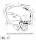 Fig. 29 - DEVICE, SYSTEM, AND METHOD FOR TRANSCATHETER TREATMENT OF VALVULAR REGURGITATION