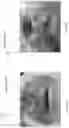 Fig. 33 - DEVICE, SYSTEM, AND METHOD FOR TRANSCATHETER TREATMENT OF VALVULAR REGURGITATION