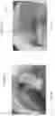 Fig. 34 - DEVICE, SYSTEM, AND METHOD FOR TRANSCATHETER TREATMENT OF VALVULAR REGURGITATION