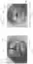 Fig. 35 - DEVICE, SYSTEM, AND METHOD FOR TRANSCATHETER TREATMENT OF VALVULAR REGURGITATION