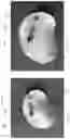 Fig. 41 - DEVICE, SYSTEM, AND METHOD FOR TRANSCATHETER TREATMENT OF VALVULAR REGURGITATION