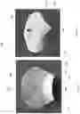 Fig. 66 - DEVICE, SYSTEM, AND METHOD FOR TRANSCATHETER TREATMENT OF VALVULAR REGURGITATION