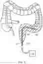 Fig. 10 - INTERNAL ULTRAVIOLET THERAPY