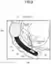 Fig. 09 - MEDICAL SYSTEM AND CANNULATION METHOD