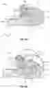 Fig. 71 - Facet joint replacement device and methods of use