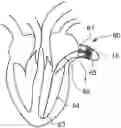 Fig. 01 - DEVICE FOR OCCLUSION OF A LEFT ATRIAL APPENDAGE OF A HEART