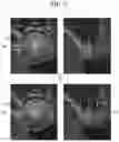 Fig. 08 - MAXILLARY SINUS LIFTING SIMULATION METHOD AND APPARATUS THEREFOR
