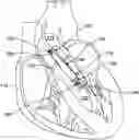 Fig. 01 - VARIABLE STIFFNESS CANNULA