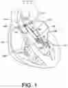 Fig. 02 - VARIABLE STIFFNESS CANNULA