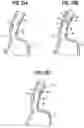 Fig. 09 - ABLATION DEVICE FOR ATTACHMENT TO AN ENDOSCOPE