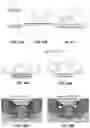 Fig. 22 - Palatal expanders for controlling crown tipping