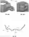 Fig. 28 - Palatal expanders for controlling crown tipping