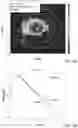 Fig. 10 - Diffusing alpha-emitter radiation therapy for colorectal cancer