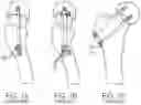 Fig. 02 - BONE FIXATION ASSEMBLY