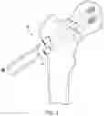 Fig. 07 - BONE FIXATION ASSEMBLY