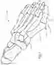 Fig. 02 - BONE SLIVER REMOVAL SYSTEM