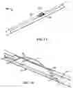 Fig. 02 - Devices and methods for forming a fistula