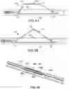 Fig. 06 - Devices and methods for forming a fistula