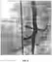 Fig. 07 - METHODS AND DEVICES FOR ENDOVASCULAR ABLATION OF A SPLANCHNIC NERVE