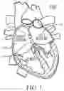 Fig. 02 - Systems, devices, and methods for forming an anastomosis