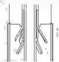 Fig. 07 - Systems, devices, and methods for forming an anastomosis