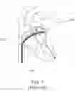 Fig. 02 - CONCENTRIC TUBE ROBOTS WITH IMPROVED STABILITY FOR MINIMALLY INVASIVE SURGERY