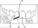 Fig. 01 - Kit and Method for Home Use for Interproximal Reduction (IPR) Stripping of Teeth for Braces or Aligners