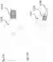 Fig. 35 - LEFT ATRIAL APPENDAGE CLOSURE