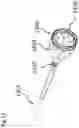 Fig. 43 - LEFT ATRIAL APPENDAGE CLOSURE