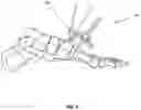 Fig. 02 - BONE ALIGN AND JOINT PREPARATION DEVICE AND METHOD