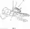 Fig. 06 - BONE ALIGN AND JOINT PREPARATION DEVICE AND METHOD