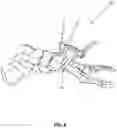 Fig. 07 - BONE ALIGN AND JOINT PREPARATION DEVICE AND METHOD