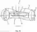 Fig. 11 - INTRAOCULAR LENSES AND PERIPHERAL PORTION STABILIZATION