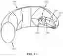 Fig. 12 - INTRAOCULAR LENSES AND PERIPHERAL PORTION STABILIZATION