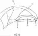 Fig. 14 - INTRAOCULAR LENSES AND PERIPHERAL PORTION STABILIZATION