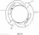 Fig. 16 - INTRAOCULAR LENSES AND PERIPHERAL PORTION STABILIZATION