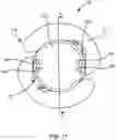 Fig. 18 - INTRAOCULAR LENSES AND PERIPHERAL PORTION STABILIZATION