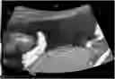 Fig. 01 - Method and system for automatically analyzing placenta insufficiency in a curved topographical ultrasound image slice